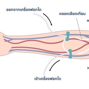 ข้อปฎิบัติตัวสำหรับผู้ป่วยระยะหลังผ่าตัด ที่ทําการตัดต่อเส้นเลือดที่แขน