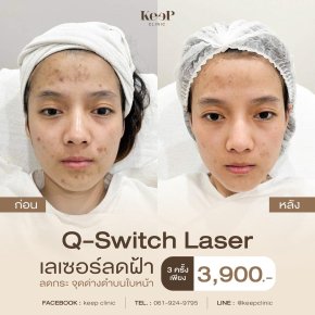 Q Switch Laser