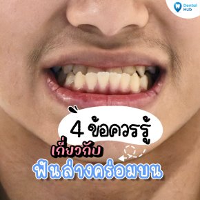 ฟันคร่อมควรแก้ไขก่อนอายุเท่าไหร่?