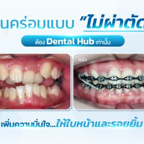 ฟันคร่อมแบบไม่ผ่าตัด ต้องเดนทัลฮับ เท่านั้น