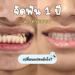 ฟันหน้าคร่อม ปีแรก เห็นความเปลี่ยนแปลงอย่างไรบ้าง?