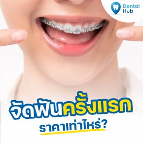 จัดฟันครั้งแรก ราคาเท่าไหร่?