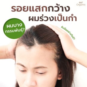 รอยแสกกว้าง! ผมร่วงเป็นกำ! ใช่ผมบางกรรมพันธุ์หรือเปล่า รับมืออย่างไรดี??