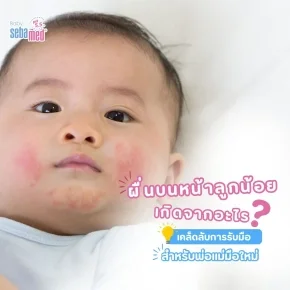 ผื่นบนหน้าลูกน้อย