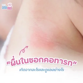 ผื่นในซอกคอ
