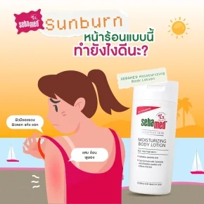 Sunburn