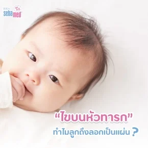 ‘ไขบนหัวทารก’_ทำไมลูกถึงลอกเป็นแผ่น
