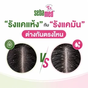 รังแคมีกี่ชนิด