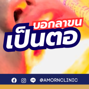 LASER HAIR REMOVAL | เลเซอร์กำจัดขน