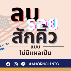 ลบรอยสัก