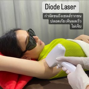 Diode Laser กำจัดขน โรสเบลล์คลินิก