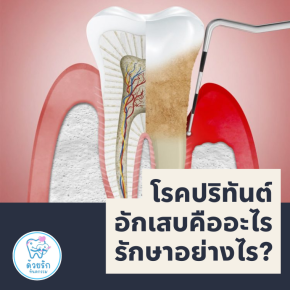 โรคปริทันต์อักเสบคืออะไร รักษาอย่างไร