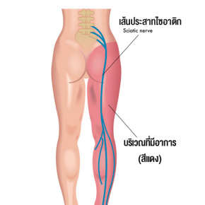  ทุกอย่างที่คุณต้องรู้เกี่ยวกับ #โรคปวดหลังร้าวขา: ทุพพลภาพ-อัมพาตได้ แต่ก็รักษาให้หายได้ ในราคาหลักพัน 