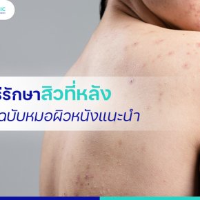 7 วิธีรักษาสิวที่หลัง แบบฉบับหมอผิวหนังแนะนำ