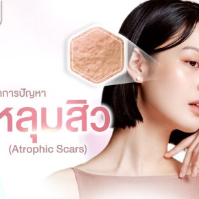 หลุมสิว (Atrophic Scars)