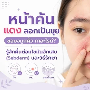  เซฟเดิร์ม_หน้าแห้ง_ลอก_ทาอะไรดี_วิธีรับมือและรักษาโรคต่อมไขมันอักเสบ.