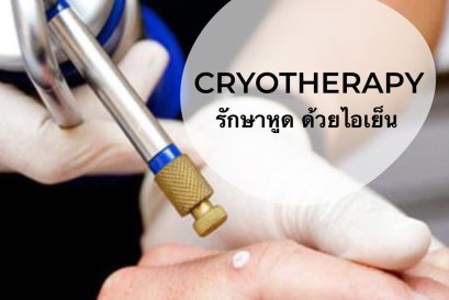 รักษาหูดที่ผิวหนังด้วยไอเย็น ไม่ต้องผ่าตัด