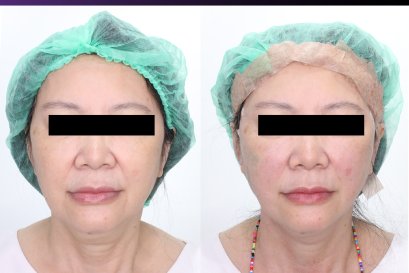 ไหมโครงตาข่าย Tesslift ยกกระชับหน้า ที่สุด ณ ตอนนี้