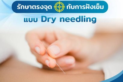 ฝังเข็ม Dry needling