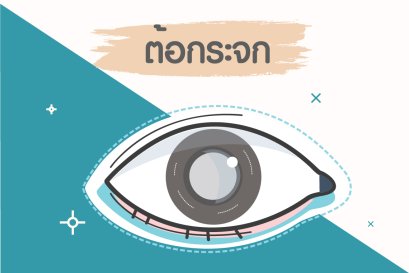 " ต้อกระจก "