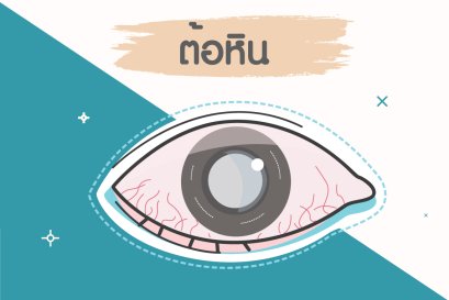 " ต้อหิน "
