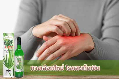 ทางเลือกใหม่ โรคสะเก็ดเงิน