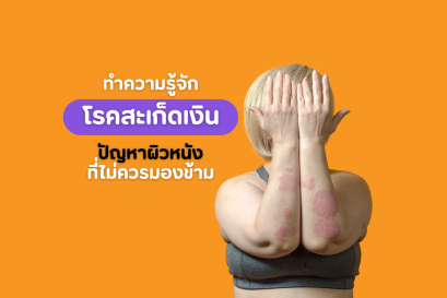 โรคสะเก็ดเงิน ปัญหาผิวหนังที่ไม่ควรมองข้าม