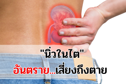 สัญญาณเตือน 5 ประการของนิ่วในไต