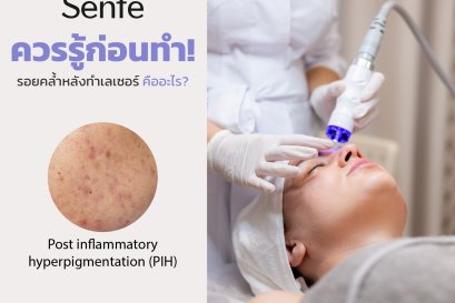 รอยคล้ำหลังทำเลเซอร์คืออะไร? ทำไมต้องควรรู้ก่อนทำ?