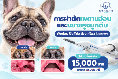 การผ่าตัดเพดานอ่อนและขยายรูจมูกตีบ เจ็บน้อย ฟื้นตัวไว ด้วยเครื่อง Ligasure
