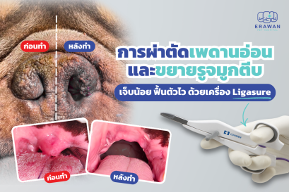 การผ่าตัดเพดานอ่อนและขยายรูจมูกตีบ เจ็บน้อย ฟื้นตัวไว ด้วยเครื่อง Ligasure