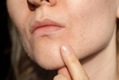 ผิวหน้าแห้งมาก ใช้ครีมอะไรดี?