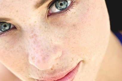 หน้าเป็นฝ้า