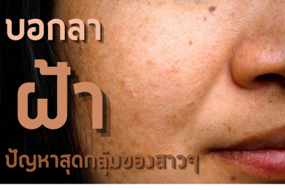 บอกลา "ฝ้า" ปัญหาสุดกลุ้มของสาวๆ