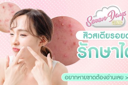 สิวสเตียรอยด์ รักษาได้