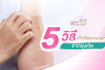 5 วิธี กำจัดรอยดำจากยุงกัด