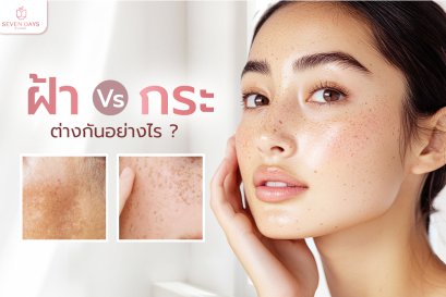 ฝ้า และ กระ ต่างกันอย่างไร