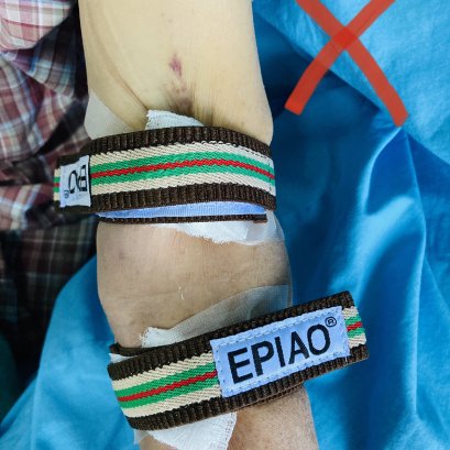 ข้อควรระวังในการหยุดห้ามเลือด