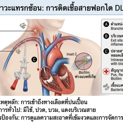 ภาวะการติดเชื้อในสายฟอกไตDLC 