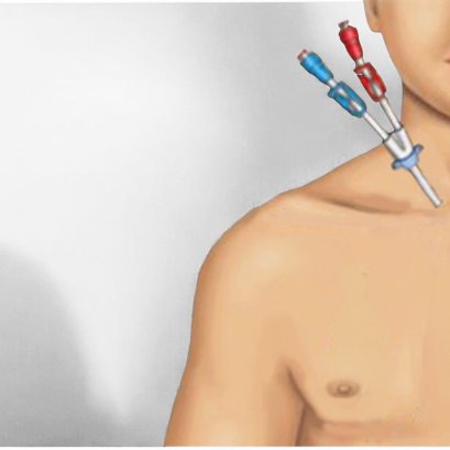 สายฟอกไตชั่วคราว(DLC) คืออะไร? 