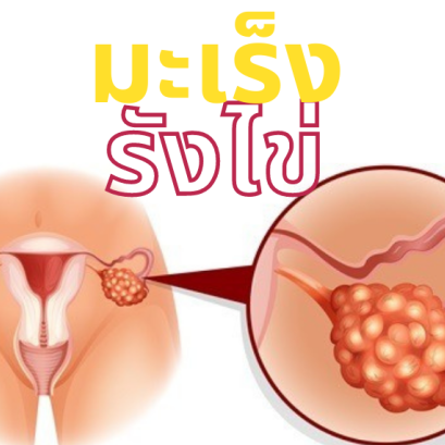 มะเร็งรังไข่ในผู้หญิง