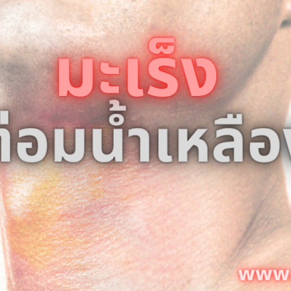 จุดการเกิดมะเร็งต่อมน้ำเหลือง