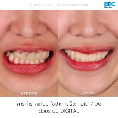 Full Mouth Implant Rehabilitation (for Upper Arch) With Full Digital Workflow in 7 Days 