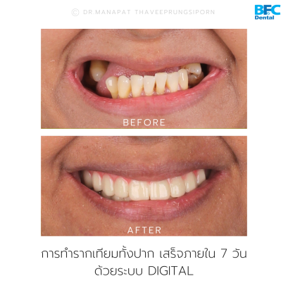 Smile Transformation in 7 Days 