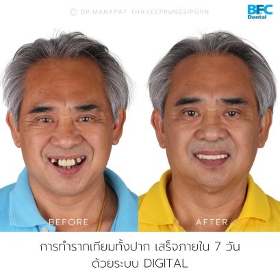 S - Arch Concept Case (Short Arch Occlusion with Immediate Loading Protocols) 4 Upper Implants and 4 Lower Implants