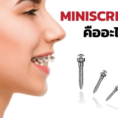 หมุดจัดฟัน (Mini-Screws) คืออะไร มีประโยชน์อย่างไรนะ?