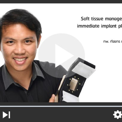 Soft Tissue Immediate Implant