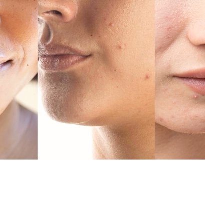 Ep.7 ประเภทผิว