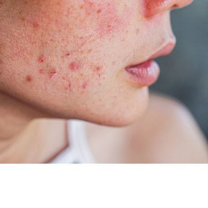 Ep.8 ปัญหาสิว