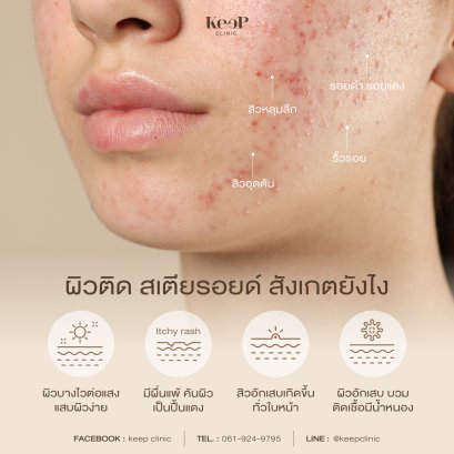 ผิวติด สเตียรอยด์ สังเกตุยังไง